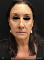 Around The Eye Fillers