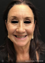 Around The Eye Fillers