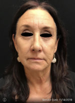 Around The Eye Fillers
