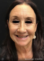 Around The Eye Fillers