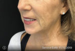 Around The Mouth Fillers