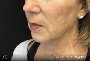 Around The Mouth Fillers