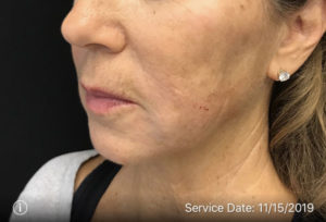 Around The Mouth Fillers