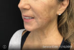 Around The Mouth Fillers