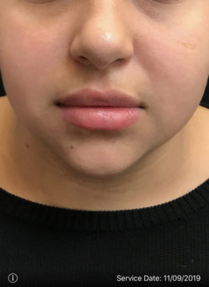 Lip Augmentation