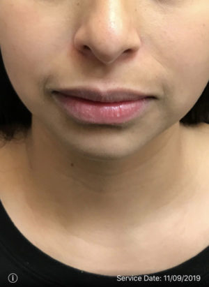Lip Augmentation