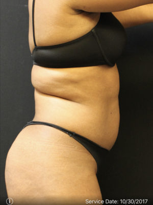 Liposuction