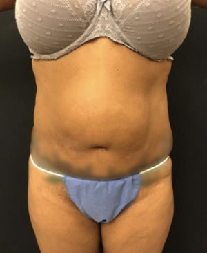 EMSCULPT