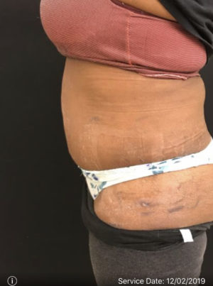 Abdominal Panniculectomy