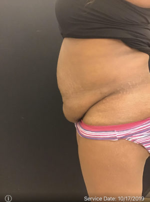 Abdominal Panniculectomy