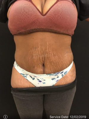 Abdominal Panniculectomy
