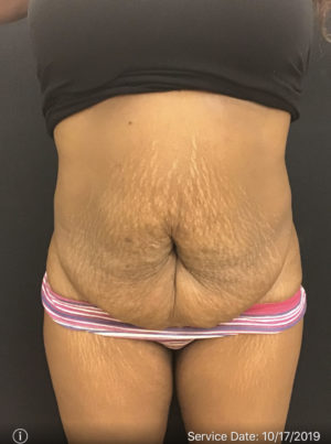 Abdominal Panniculectomy