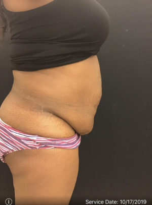 Abdominal Panniculectomy