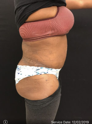 Abdominal Panniculectomy