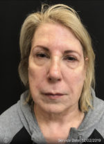 Around The Eye Fillers