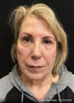Around The Eye Fillers