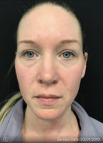 Around The Eye Fillers