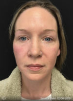 Around The Eye Fillers