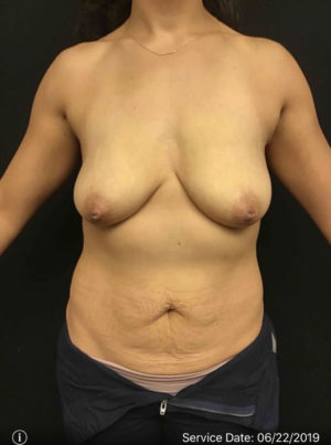 Breast Lift