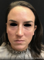 Around The Eye Fillers