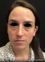 Around The Eye Fillers