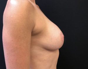 Breast Lift
