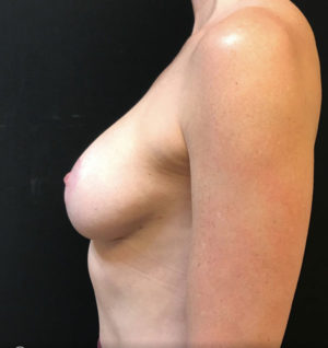 Breast Lift