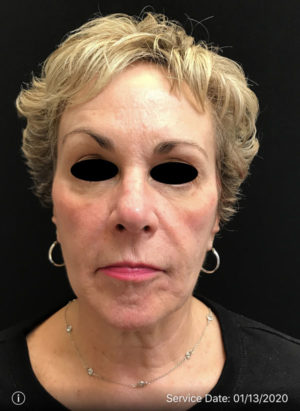 Around The Eye Fillers