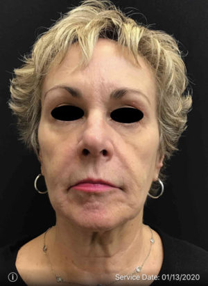 Around The Eye Fillers