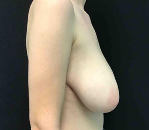 Breast Reduction