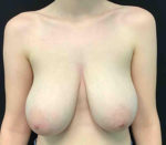 Breast Reduction