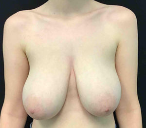 Breast Reduction