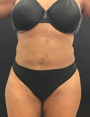 Liposuction