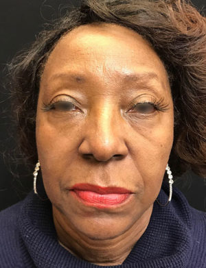 Around The Eye Fillers