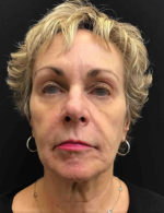 Around The Eye Fillers