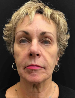 Around The Eye Fillers
