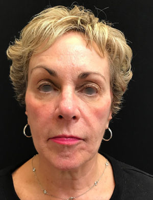 Around The Eye Fillers