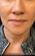 Lip Augmentation