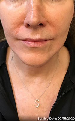 Juvederm