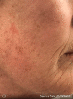 Actinic Keratoses