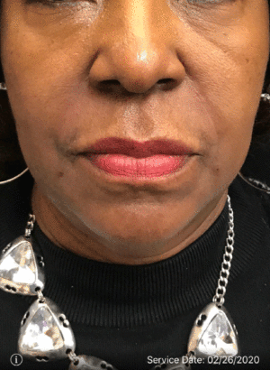 Around The Mouth Fillers