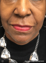 Around The Mouth Fillers