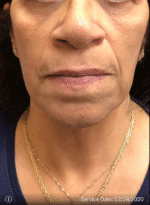 Around The Mouth Fillers