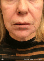 Around The Mouth Fillers