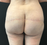 Fat Transfer - Gluteal