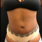 Tummy Tuck