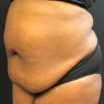 Tummy Tuck