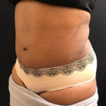 Tummy Tuck