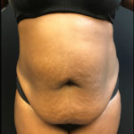 Tummy Tuck