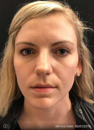 Around The Eye Fillers